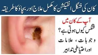 Fungal Ear Infection (Otomycosis) in Urdu | Kaan Mein Fungus Ka Ilaj, Alamat Aur Asbab