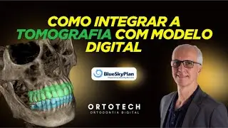 Integração de Tomografia com Modelo Digital no Blue Sky Plan
