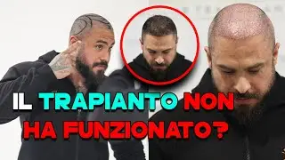 Ho rifatto il trapianto per i capelli (per la seconda volta 🤦🏻‍♂️)