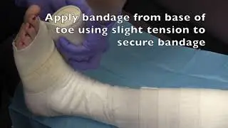 Application of surepress, long stretch compression bandage