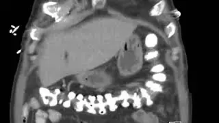 APCoronal