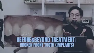 How to Replace a Broken Front Tooth (IMPLANTS) | BEFORE & BEYOND EP26