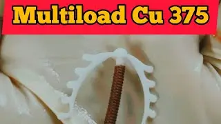 Multiload Cu 375.#obstetricsandgynecology Intrauterine Contraceptive Device #contraceptivedevice