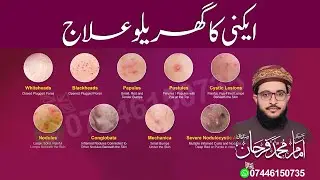Acne Home Remedies | Best Natural Treatments to Remove Pimples & Get Clear Skin Fast