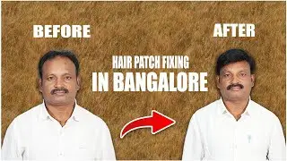 Hair Patch Fixing in Bangalore &ndash; Real Results in Just 1 Hour!