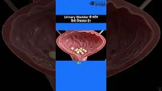 How stones comes out of the urinary bladder | how stones get removed easily