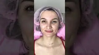 Ботокс - фул фейс / Botox - Full Face