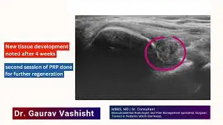 Young Wrestler&rsquo;s Elbow Dislocation | MSK Intervention Case Study || Dr Gaurav Vashisht #mskradiology