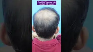 Bad Hair Transplant | Synthetic Hair Transplant | Hair transplant results | #shorts #youtubeshorts