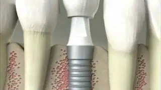 What Is a dental implant Delray Beach Dentist