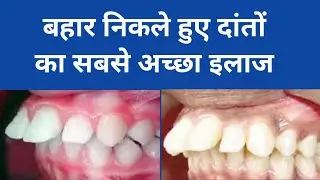 बहार निकले हुए दांतों का इलाज//टेढ़े मेढ़े दांतों का इलाज//Smile design treatment//smile makeover