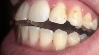 || Invisalign treatment process ||