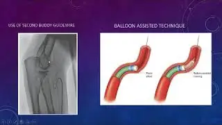 Radial artery loop: management