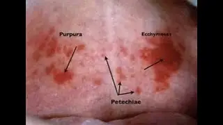Petechiae (small pinpoint hemorrhages) ; Causes, Key features, Disease association, Treatment