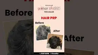 Watch your hair transform from weak and thinning to strong, healthy, and full of life with PRP