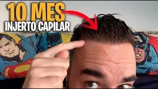 injerto capilar 10 mes de evolución Técnica FUE SIN RAPAR