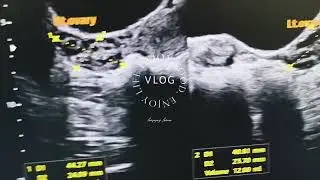 Bilateral Polycystic ovarian disease in ultrasound views.