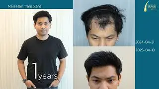 เคยรักษามาหลายทาง แต่ปลูกผมคือคำตอบ รีวิวปลูกผม 11 เดือน  || Ultima Hair Center  ปลูกผมหมอหมิง