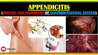 APPENDICITIS | CAUSES OF APPENDICITIS | PATHOPHYSIOLOGY OF APPENDICITIS | SIGN AND SYMPTOMS | TYPES