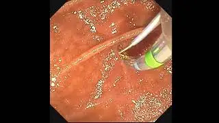 Submucosal injection to facilitate needle-knife sphincterotomy: a novel technique
