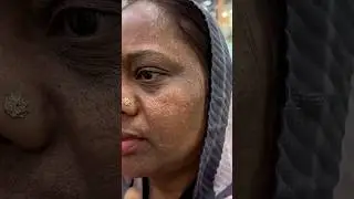 7Days Dark Spots, Melasma & Pigmentation Removal Challenge | Get Clear Glowing & Spotless Skin