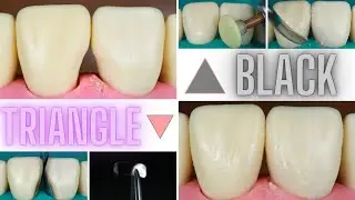 Restoring Black Triangles using Resin Composite
