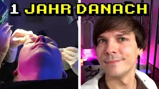 Wie sieht eine Haartransplantation ein Jahr später aus?