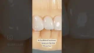 A Conservative approach while reducing as little as possible really can yield awesome esthetics! 🦷
