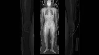 Whole Body X Ray Image