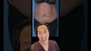 Great Tummy Tuck Results by Dr. Youn! #tummytucksurgery #tummytuckbeforeandafter #confidence #happy