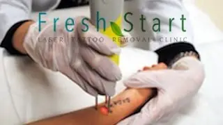 Fresh Start Laser Clinic | Army Tattoo Removal Austin TX