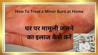 How To Treat Minor Burn At Home | Prevent Burn Scar