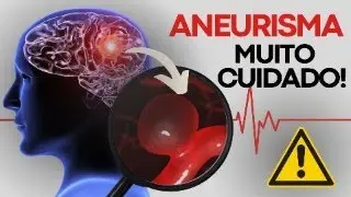SINTOMAS DE UM ANEURISMA: QUANDO DEVO ME PREOCUPAR? | Dr Dayan Siebra