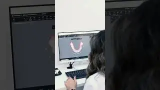 #invisalign Treatment Planning in TIMELAPSE!