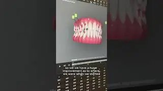 Complex Invisalign Case Success: 18 Months, Rubber Bands & Full Bite Correction