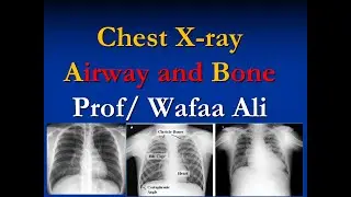 (1) استخدام الحروف الابجديه للتعليق على أشعة الصدر ABCDEF chest x-ray approach airway and bone