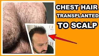 FUE SURGERY BODY HAIR TO SCALP | What Happened With His Chest Hair? #shorts #hairtransplantresults