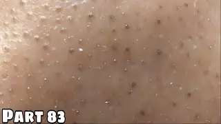 blackheads . Removing them helps this girl to be more confident | Part 83 | B'Young Spa Quyet Hair