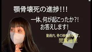 No,134【乳がんステージ４】これで終わりか？顎骨壊死🦷体験談