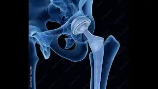Orthopedic Implants & Surgical Instruments Manufacturer in India (Delhi) &ndash; Sofia Surgicals