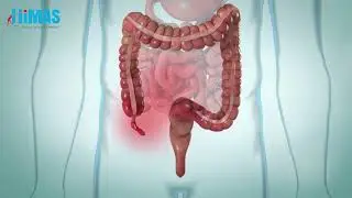 Laparoscopic Appendectomy Procedure | Safe & Advanced Appendix Surgery at Himas Hospital Bangalore