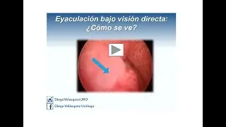 Eyaculaci&oacute;n bajo visi&oacute;n cistoscopica &iquest;C&oacute;mo se ve?