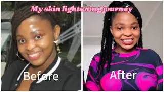 My skin lightening journey (how I lightened my skin with proof pictures) ||South African YouTuber