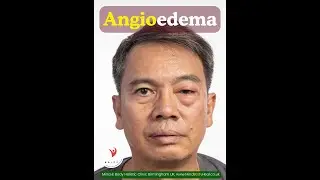 Angioedema  - puffy, swollen eyes, lips, hands, feet or throat etc., and how to prevent recurrence