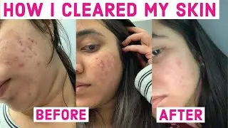 How i cleared my stubborn ACNE and ACNE SCARS | Proactive results and review.