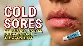 👄 COLD SORES: SYMPTOMS, CAUSES, PREVENTION & TREATMENT👄