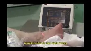 Tratamento / Cirurgia de Varizes perfurante &agrave; Laser (endolaser - EVLT)