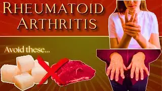 Rheumatoid Arthritis: Foods to Avoid & Foods to Embrace #rheumatoid_arthritis #rheumatoidarthritis