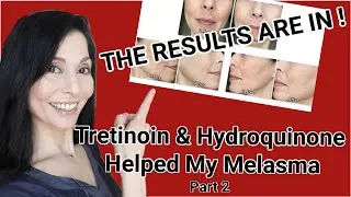 My Melasma Results with Tretinoin and Hydroquinone: (Part 2 of 2)