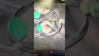 POV clinical step by step video of endo retx of tooth #19.